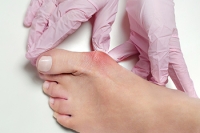 All About Bunions