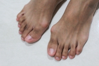 Facts About Bunions