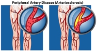 Causes and Risk Factors for PAD