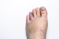 Types of Broken Toes and Relief Options