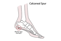 Symptoms and Risk Factors of Heel Spurs