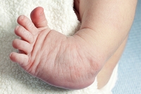 Various Congenital Foot Conditions